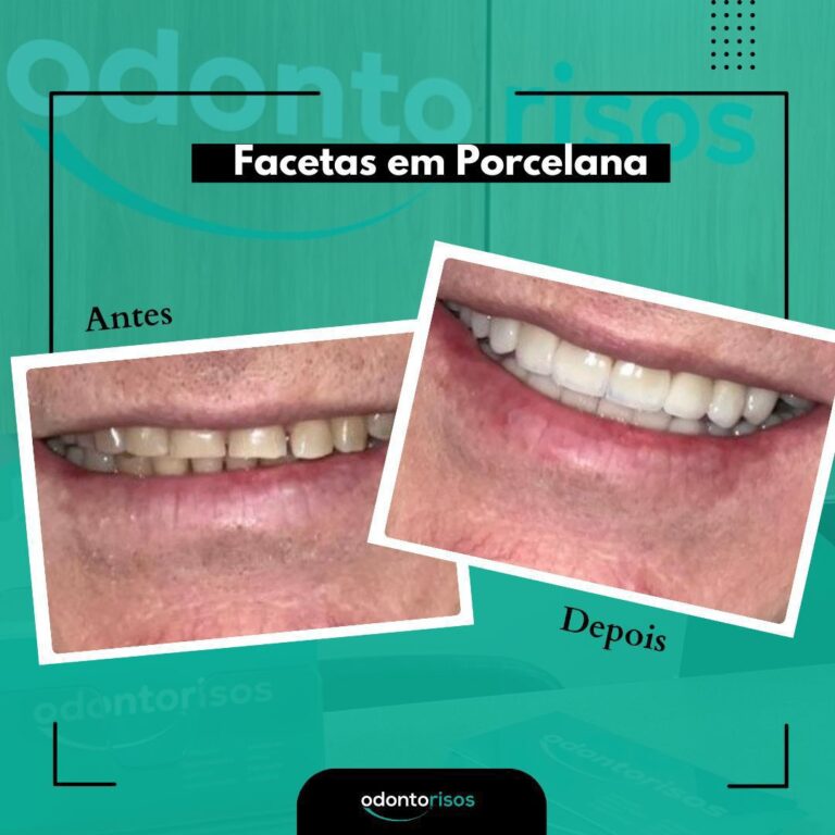 lente_de_porcelana_em_brasília